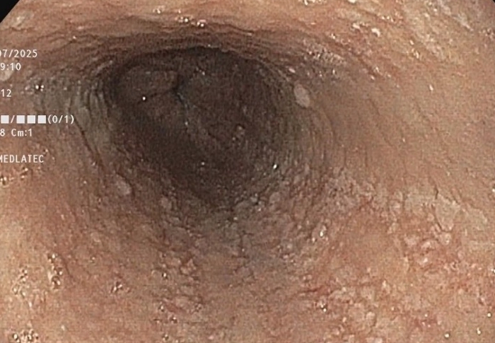 Người phụ nữ đi khám vì nuốt nghẹn, phát hiện 6 bệnh cùng lúc - Ảnh 1.