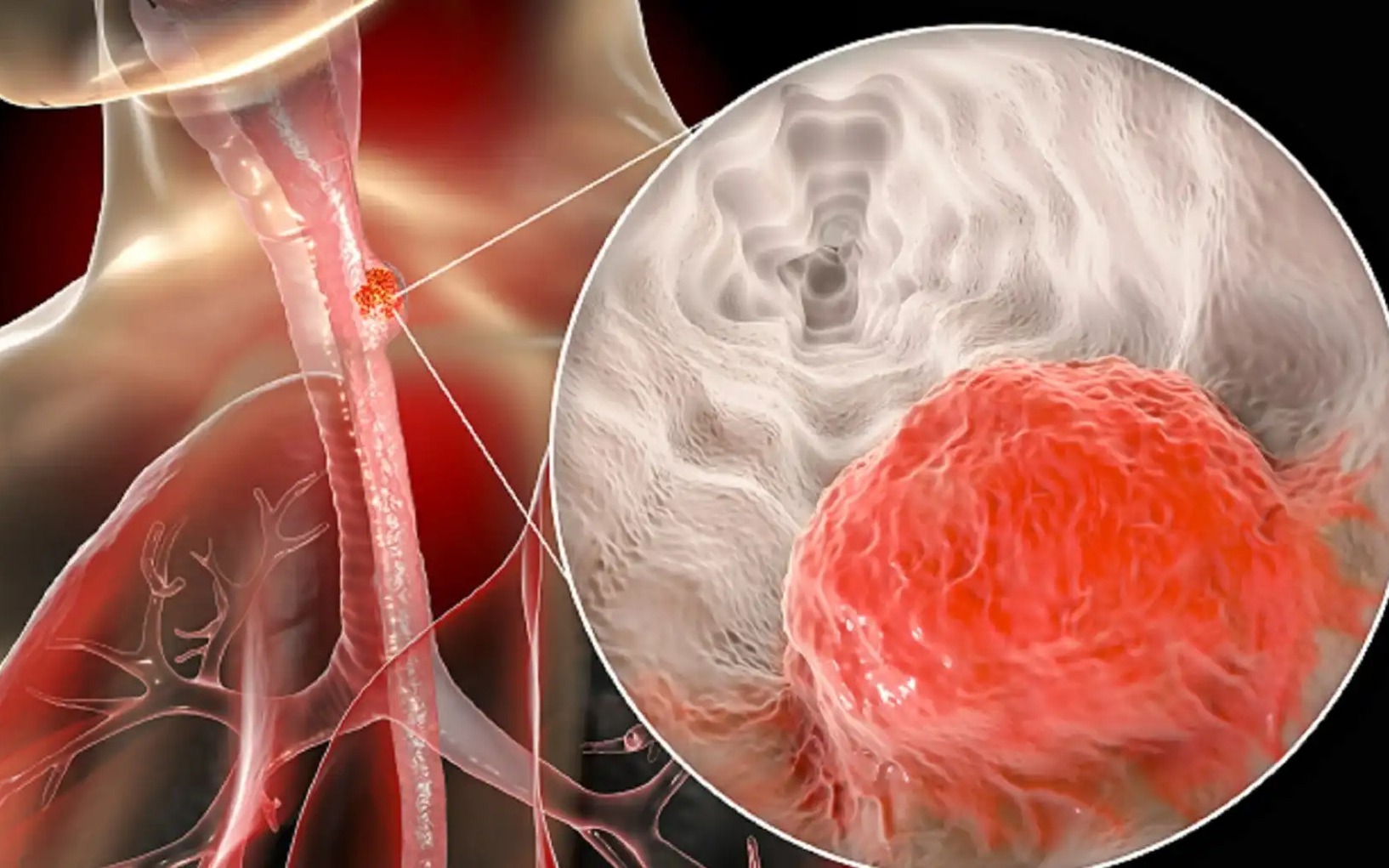 Nam giám đốc bất ngờ phát hiện ung thư giai đoạn 3: Hối hận vì đã bỏ qua 1 dấu hiệu suốt nhiều năm