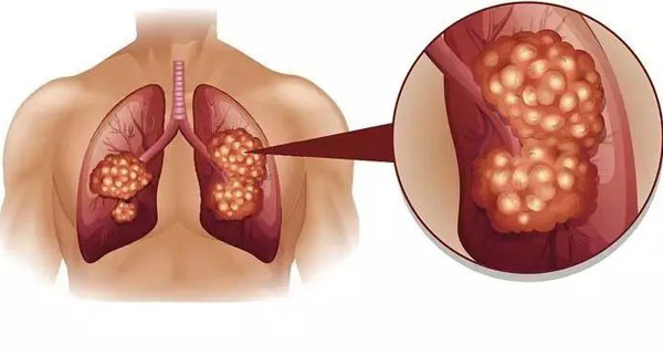 Tại Sao Ung Thư Phổi Lại “Nhắm” Vào Những Người Không Hút Thuốc? Có 1 Thứ Trong Bếp Là Tại Sao Ung Thư Phổi Lại “Nhắm” Vào Những Người Không Hút Thuốc? Có 1 Thứ Trong Bếp Là