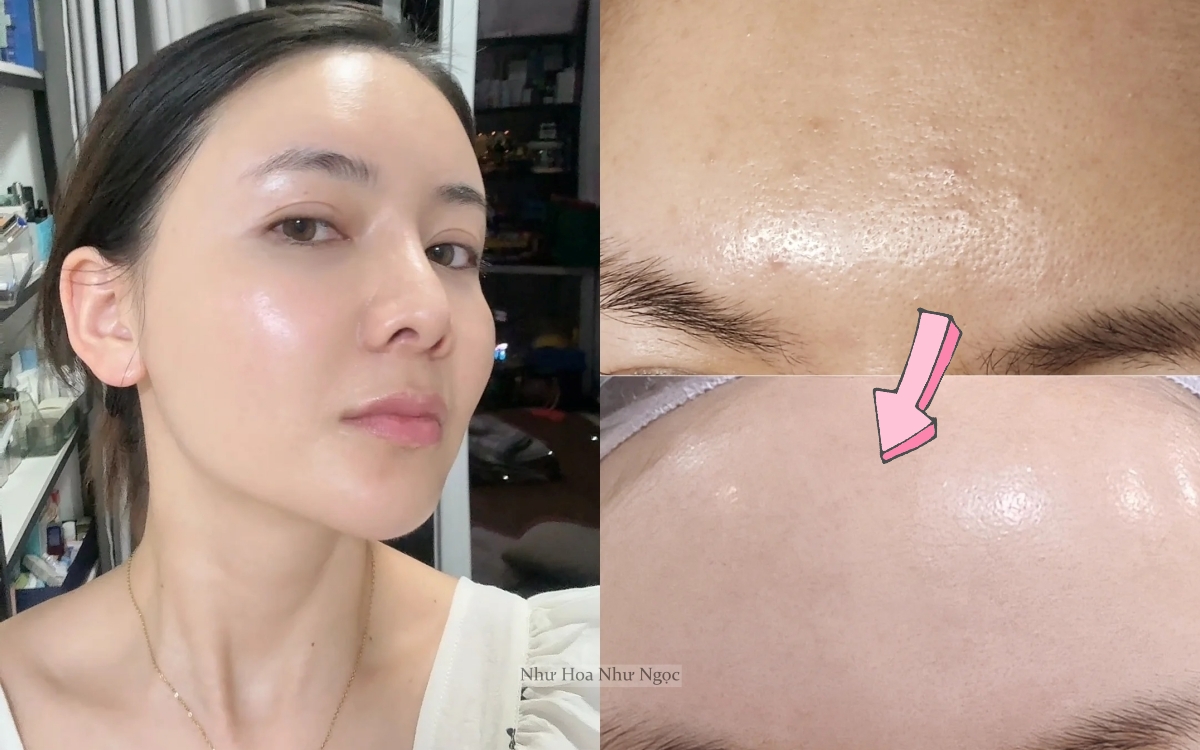 Thạc Sĩ 36 Tuổi Chia Sẻ Hành Trình Trị Mụn Ẩn Khoa Học: Da Sần Sùi Hóa Láng Mịn Chỉ Nhờ Hiểu Đúng- Ảnh 1. Thạc Sĩ 36 Tuổi Chia Sẻ Hành Trình Trị Mụn Ẩn Khoa Học: Da Sần Sùi Hóa Láng Mịn Chỉ Nhờ Hiểu Đúng- Ảnh 1.