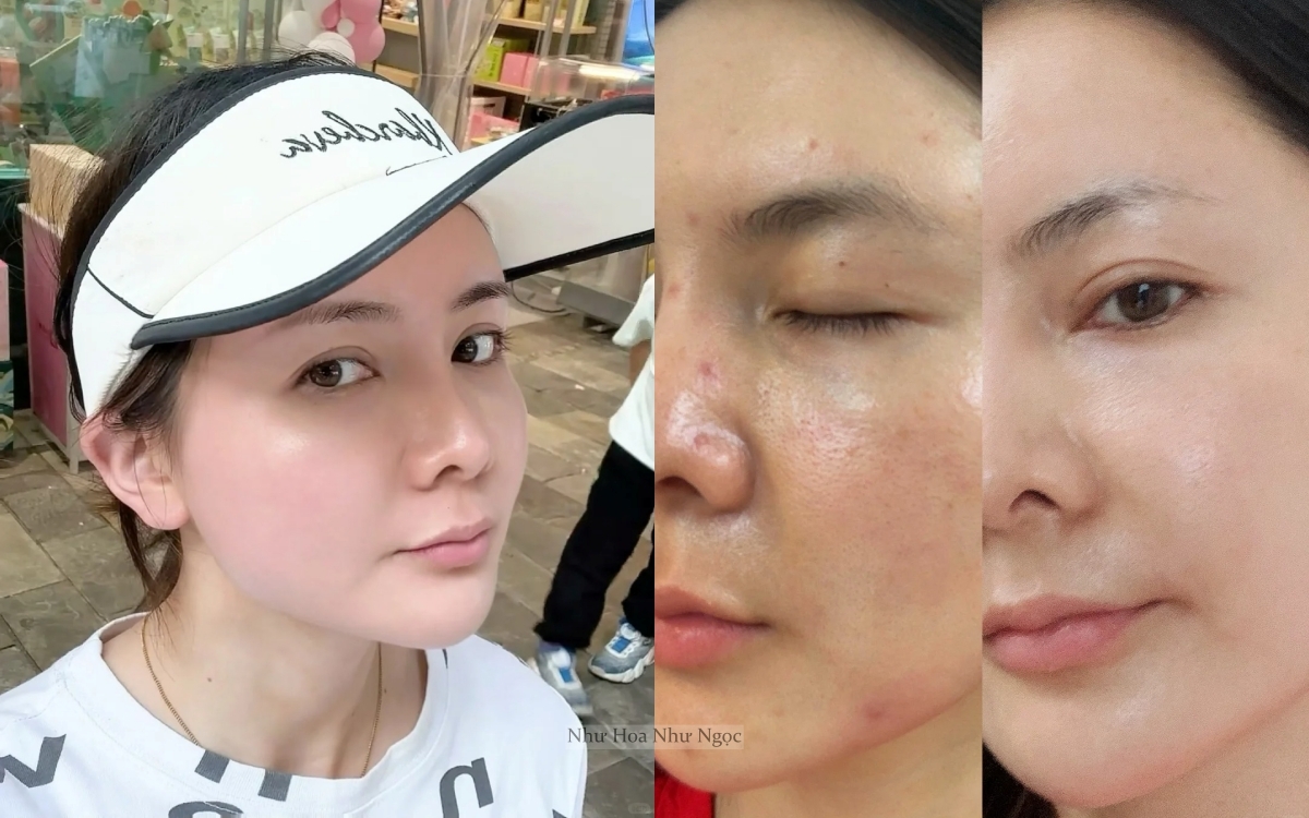 Thạc Sĩ 36 Tuổi Chia Sẻ Hành Trình Trị Mụn Ẩn Khoa Học: Da Sần Sùi Hóa Láng Mịn Chỉ Nhờ Hiểu Đúng- Ảnh 2. Thạc Sĩ 36 Tuổi Chia Sẻ Hành Trình Trị Mụn Ẩn Khoa Học: Da Sần Sùi Hóa Láng Mịn Chỉ Nhờ Hiểu Đúng- Ảnh 2.