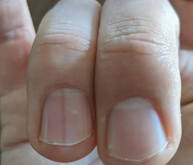 7 bất thường tr&ecirc;n m&oacute;ng tay lộ ngay người &ldquo;giấu&rdquo; khối u trong cơ thể, kiểm tra xem bạn c&oacute; kh&ocirc;ng! - Ảnh 1.