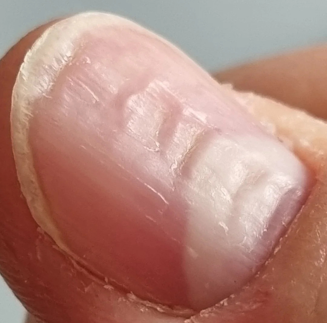 7 bất thường tr&ecirc;n m&oacute;ng tay lộ ngay người &ldquo;giấu&rdquo; khối u trong cơ thể, kiểm tra xem bạn c&oacute; kh&ocirc;ng! - Ảnh 3.