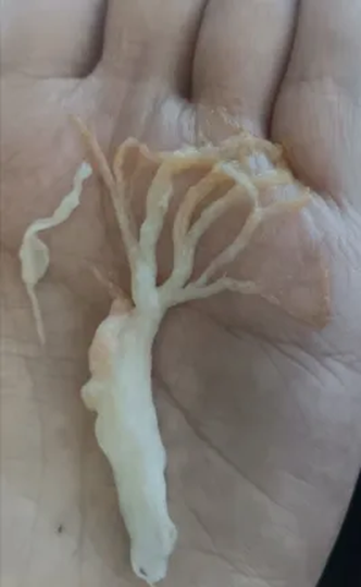 Người phụ nữ ho ra "rễ cây" - Ảnh 3.