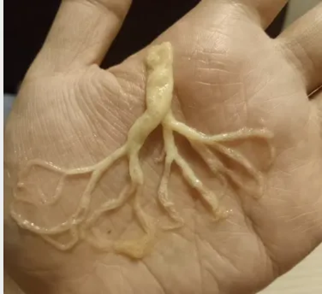 Người phụ nữ ho ra "rễ cây" - Ảnh 2.