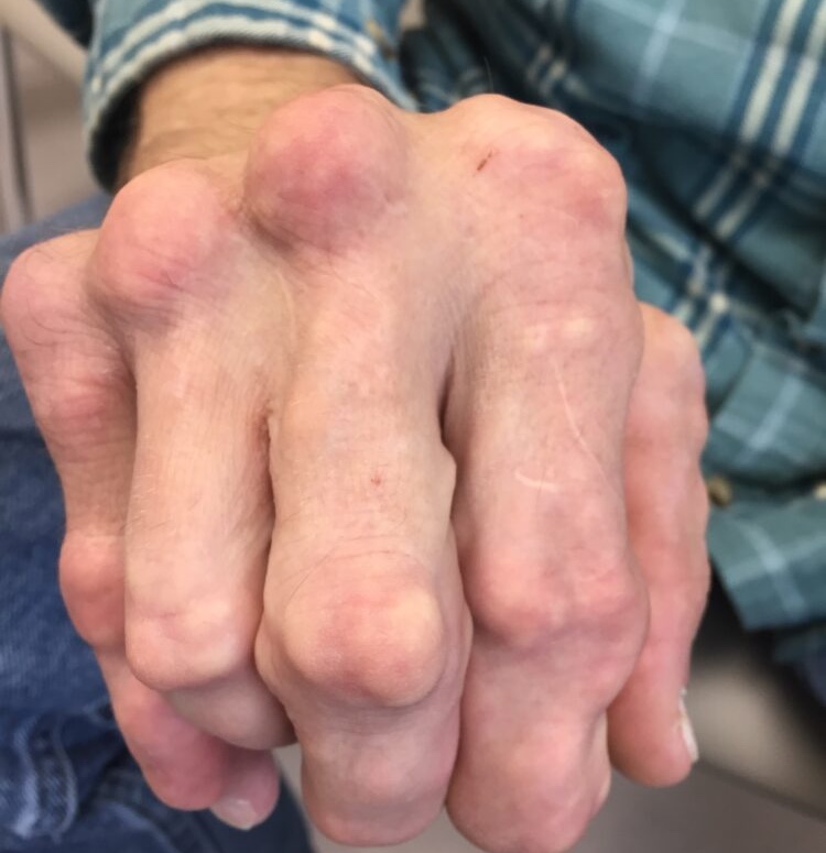 Danh sách đen 6 thực phẩm là "đồng phạm" của bệnh gout nhưng nhiều người ăn vô tội vạ - Ảnh 1. Danh sách đen 6 thực phẩm là "đồng phạm" của bệnh gout nhưng nhiều người ăn vô tội vạ - Ảnh 1.
