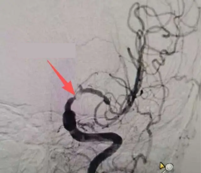 Người đàn ông đột quỵ 2 lần trong 1 tháng dù không mắc huyết áp cao hay mỡ máu: "Thủ phạm" gây bất ngờ- Ảnh 1.