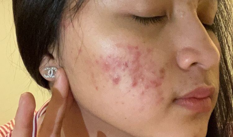 6 vị trí mọc mụn trên mặt ngầm cảnh báo cả tá bệnh: Tim, gan, thận, dạ dày đều đang "kêu cứu"- Ảnh 1.