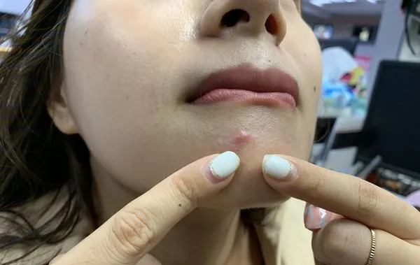 6 vị trí mọc mụn trên mặt ngầm cảnh báo cả tá bệnh: Tim, gan, thận, dạ dày đều đang "kêu cứu"- Ảnh 2.