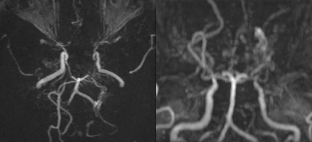 Hình Ảnh Mri Khiến Bác Sĩ Bất Ngờ: Mạch Máu Não Bệnh Nhân Mờ Như Hình Ảnh Mri Khiến Bác Sĩ Bất Ngờ: Mạch Máu Não Bệnh Nhân Mờ Như