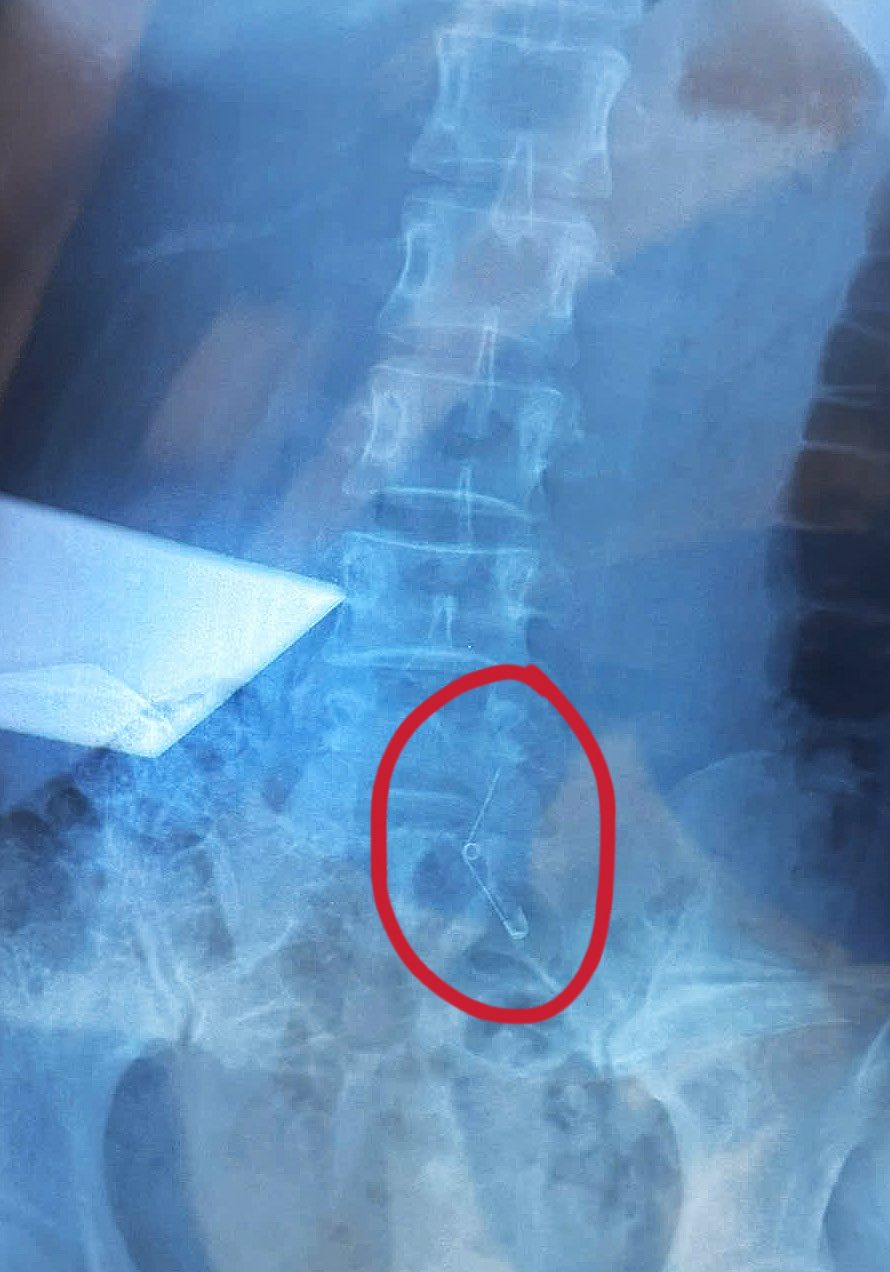 Vụ cô gái nuốt kim băng đang mở khi ăn ốc: Chính chủ nói rõ lý do nuốt vật nhọn mà không hay biết- Ảnh 3.