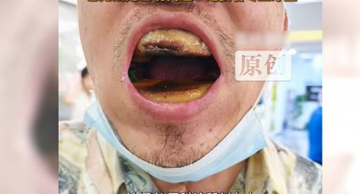 Hàm răng đáng sợ của người đàn ông tự trám nhựa, nha sỹ bất lực - Ảnh 1.