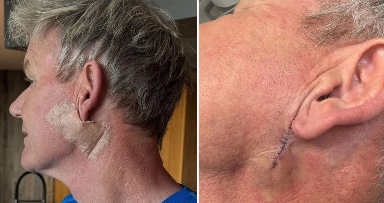 "Vua đầu bếp" Gordon Ramsay bị ung thư - Ảnh 1.