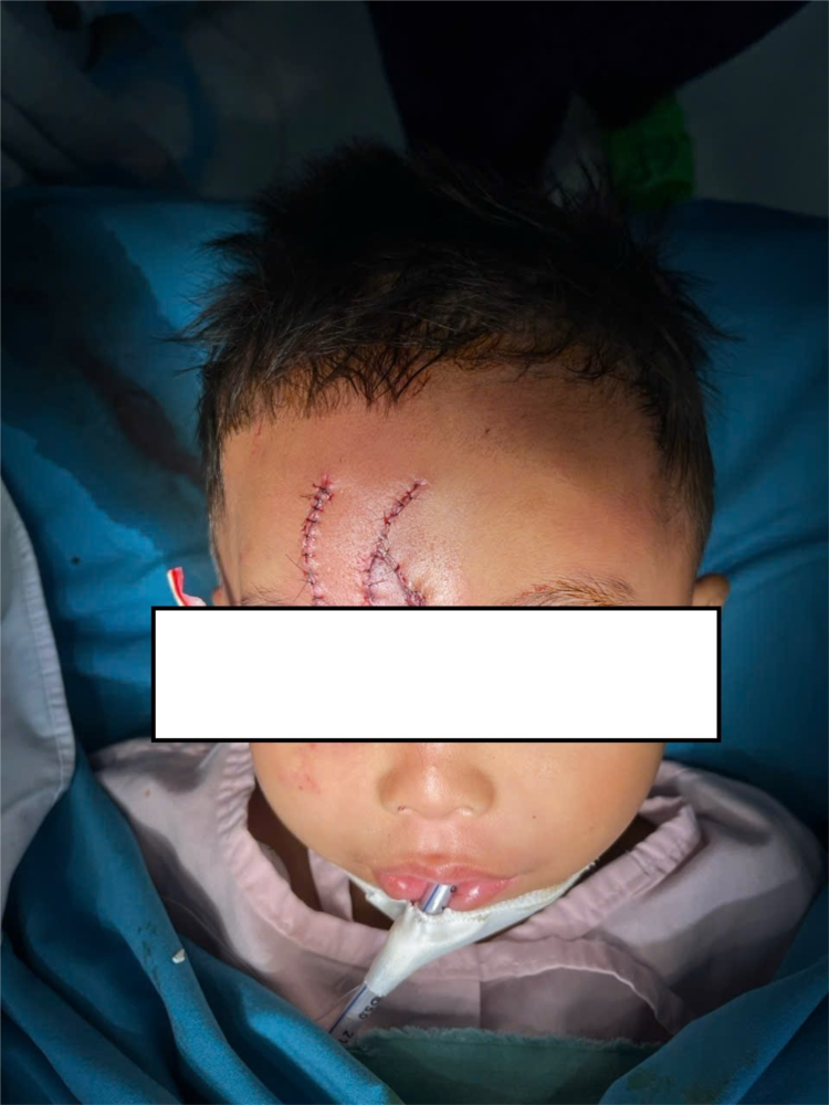 Hợp Sức Mổ Khẩn Cứu Bé Trai Bị Chó Cắn Nát Mặt Thương Tâm- Ảnh 1. Hợp Sức Mổ Khẩn Cứu Bé Trai Bị Chó Cắn Nát Mặt Thương Tâm- Ảnh 1.