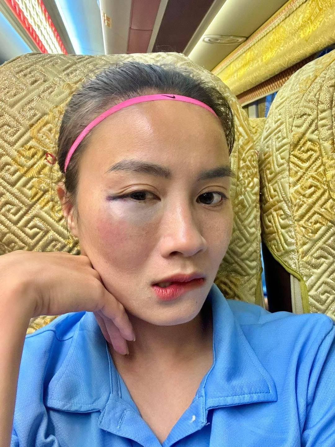 Hotgirl bóng đá Hoàng Thị Loan để bộ vùng mắt sưng vù sau pha va chạm trên sân bóng khiến fan cực xót- Ảnh 2.