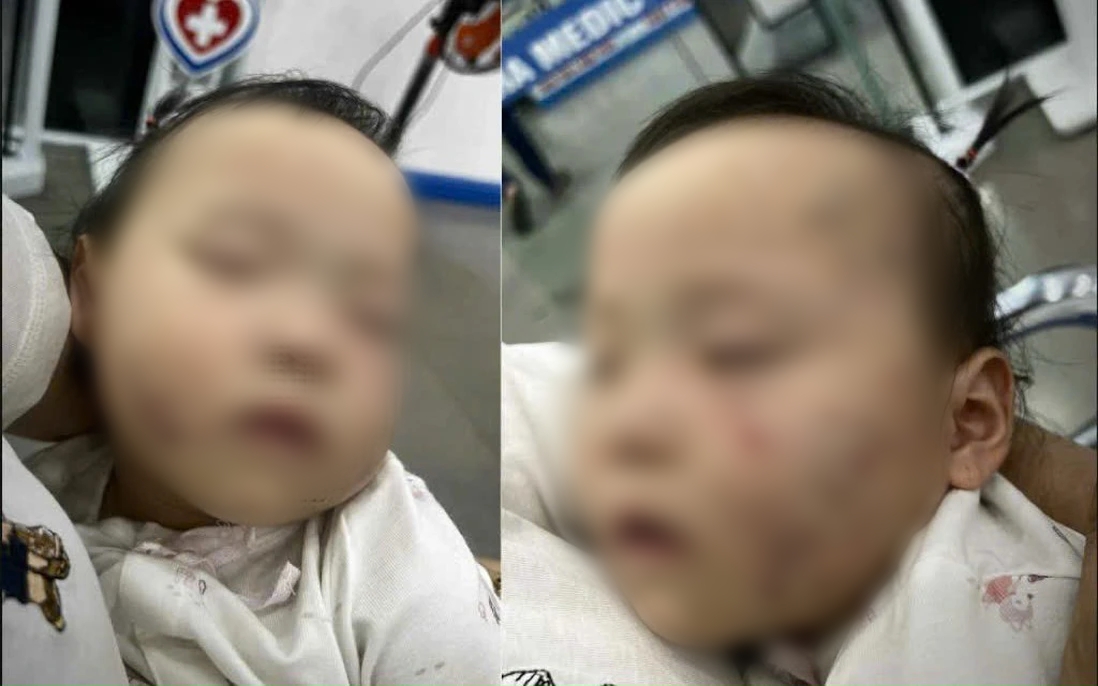Vụ bé gái bị bầm tím mặt sau khi đi học mầm non tư thục: Điều tra cô giáo Liên quan - Ảnh 1.