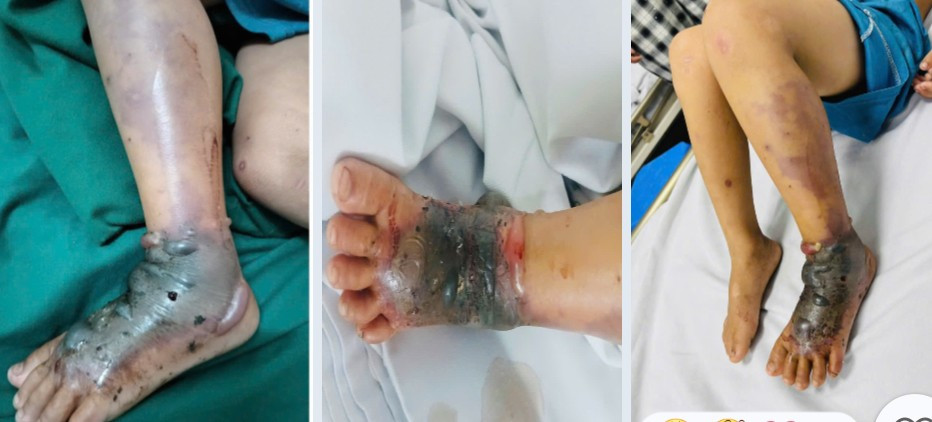 Bé trai 4 tuổi nguy kịch vì bà nội cho đắp thuốc nam chữa vết mèo cắn - Ảnh 1. Bé trai 4 tuổi nguy kịch vì bà nội cho đắp thuốc nam chữa vết mèo cắn - Ảnh 1.