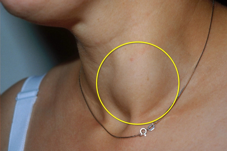 8 người một nh&agrave; c&ugrave;ng mắc ung thư tuyến gi&aacute;p, b&aacute;c sĩ nhắc nhở: Thấy 5 thay đổi n&agrave;y, e rằng "tế b&agrave;o ung thư&rdquo; đ&atilde; lớn- Ảnh 2.