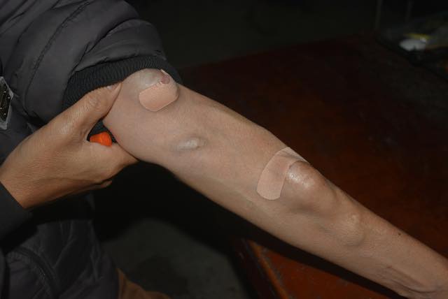 C&aacute;nh tay của người chạy thận h&oacute;a ra tr&ocirc;ng thế n&agrave;y: 1 vũ c&ocirc;ng chuy&ecirc;n mặc &aacute;o d&agrave;i tay 1 b&ecirc;n đ&atilde; "thức tỉnh" những ai kh&ocirc;ng biết- Ảnh 2.