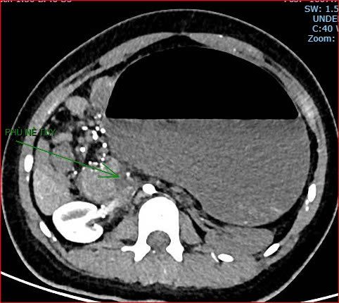 Bệnh viện Việt Nam - Cu Ba Đồng Hới th&ocirc;ng tin ca bệnh hiếm gặp g&acirc;y tử vong - Ảnh 3.