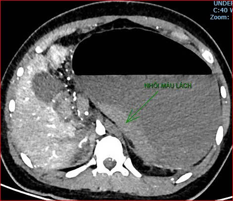 Bệnh viện Việt Nam - Cu Ba Đồng Hới th&ocirc;ng tin ca bệnh hiếm gặp g&acirc;y tử vong - Ảnh 4.