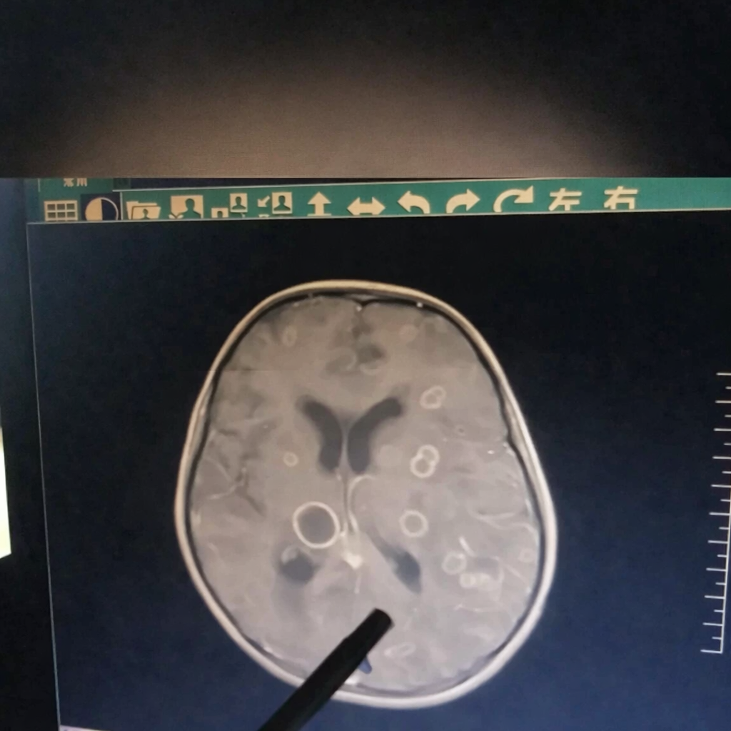 B&eacute; g&aacute;i lớp 2 n&atilde;o "bị ăn m&ograve;n chục lỗ", chậm ch&uacute;t l&agrave; rỗng ho&agrave;n to&agrave;n: Thủ phạm rất phổ biến trong mọi gia đ&igrave;nh - Ảnh 1.