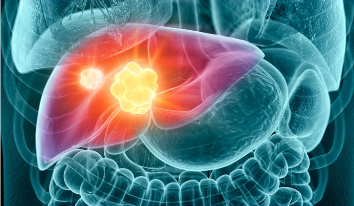 Cảnh b&aacute;o 4 dấu hiệu sớm nhất của ung thư gan - Ảnh 5.