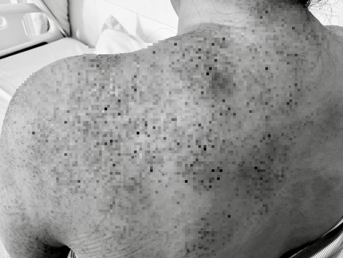 Người phụ nữ ở Vĩnh Long nhập viện cấp cứu sau khi chích lể, giác hơi - Ảnh 1.