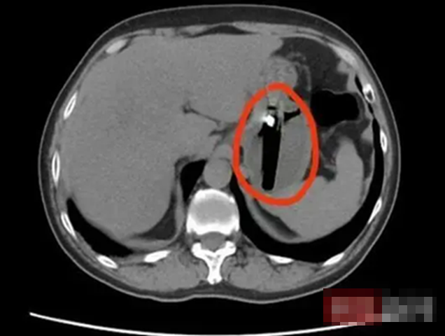 Người đ&agrave;n &ocirc;ng 36 tuổi đau bụng dữ dội, đi kh&aacute;m ph&aacute;t hiện thứ "lạ đời" kh&ocirc;ng ai nghĩ được n&oacute; nằm b&ecirc;n trong- Ảnh 1.