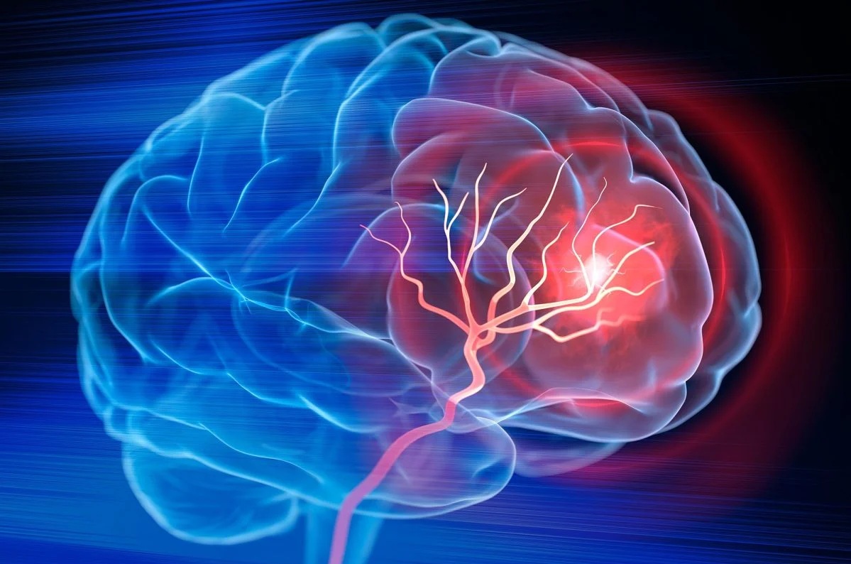 Mỹ ph&aacute;t triển phương ph&aacute;p trị đột quỵ mới, chỉ cần 1 lần truyền dịch - Ảnh 1.