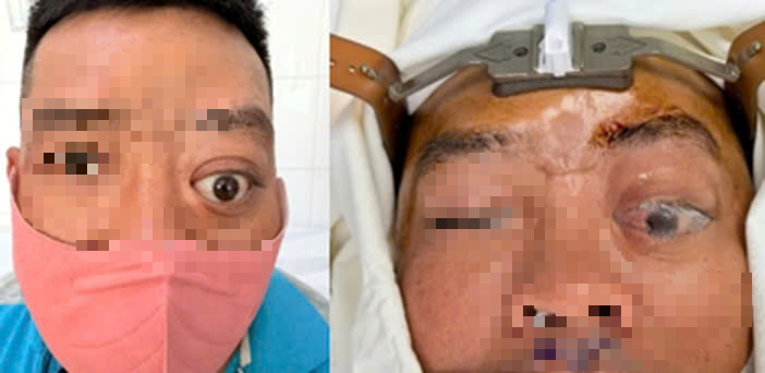 Một Ca Bệnh Mà Bệnh Viện Tai Mũi Họng Tphcm Mới Gặp Lại Trong Vòng 20 Năm Một Người Đàn Ông Mắc Bệnh Hiếm, 20 Năm Mới Gặp 2 Ca - Ảnh 1.