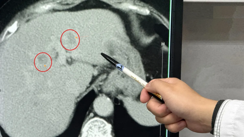 Người phụ nữ 60 tuổi mắc ung thư gan, một nửa gan là mỡ vì ngày nào cũng ăn 2 món "vạn người mê"- Ảnh 1.