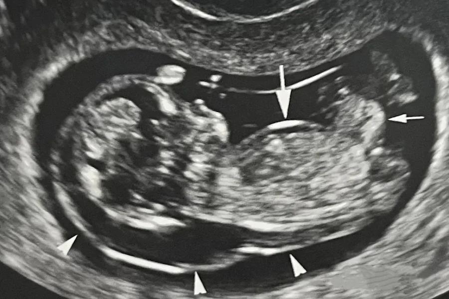 Top 4 dị t&acirc;̣t b&acirc;̉m sinh thường gặp ở trẻ sơ sinh v&agrave; giải ph&aacute;p ph&aacute;t hiện sớm từ trong bụng mẹ - Ảnh 1.