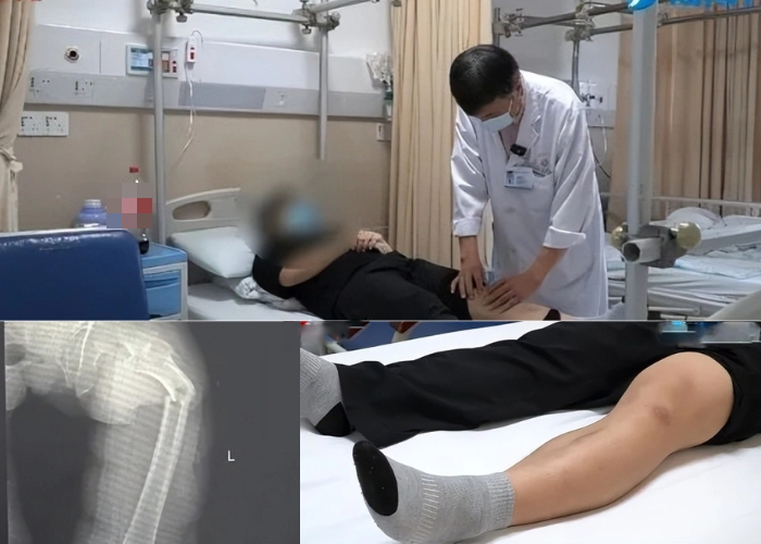 Ngoài 30 tuổi xương đã "xốp như tổ ong", ho cũng gãy xương đùi vì mê loại nước "ngòn ngọt", uống tê đầu lưỡi - Ảnh 1.