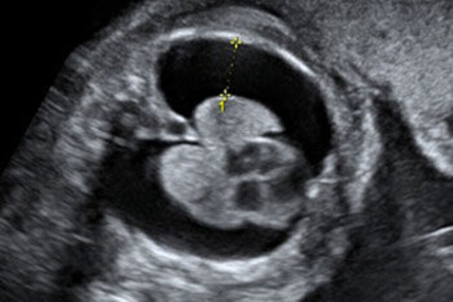 Chọc Hút Dịch Màng Phổi Thai Nhi: Can Thiệp Đúng Cách Giúp “Giữ Nhịp Thở” Cho Sự Sống Non Nớt - Ảnh 1. Chọc Hút Dịch Màng Phổi Thai Nhi: Can Thiệp Đúng Cách Giúp “Giữ Nhịp Thở” Cho Sự Sống Non Nớt - Ảnh 1.