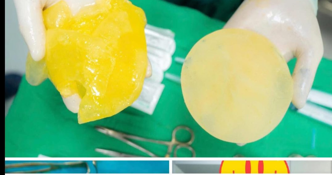 Phụ nữ đã "trùng tu" vòng 1, có được chơi Pickleball? - Ảnh 2.