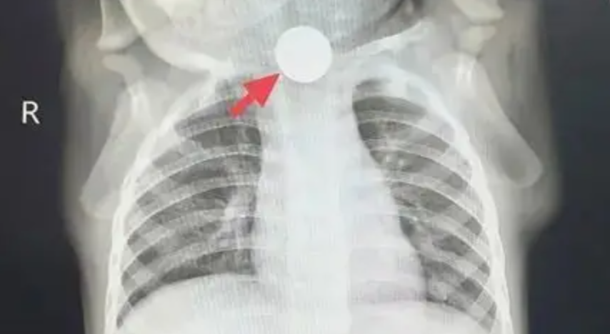 Bé trai 1 tuổi bỏ ăn cả tuần, nguyên nhân được phát hiện khiến bà nội phải thốt lên: “Đúng là lỗi của tôi”- Ảnh 1.