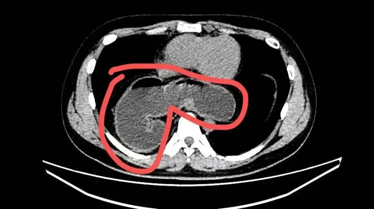 Ch&agrave;ng trai 28 tuổi một nửa dạ d&agrave;y "tr&agrave;n v&agrave;o" lồng ngực v&igrave; ng&agrave;y n&agrave;o cũng d&ugrave;ng thức uống "vạn người m&ecirc;"- Ảnh 1.