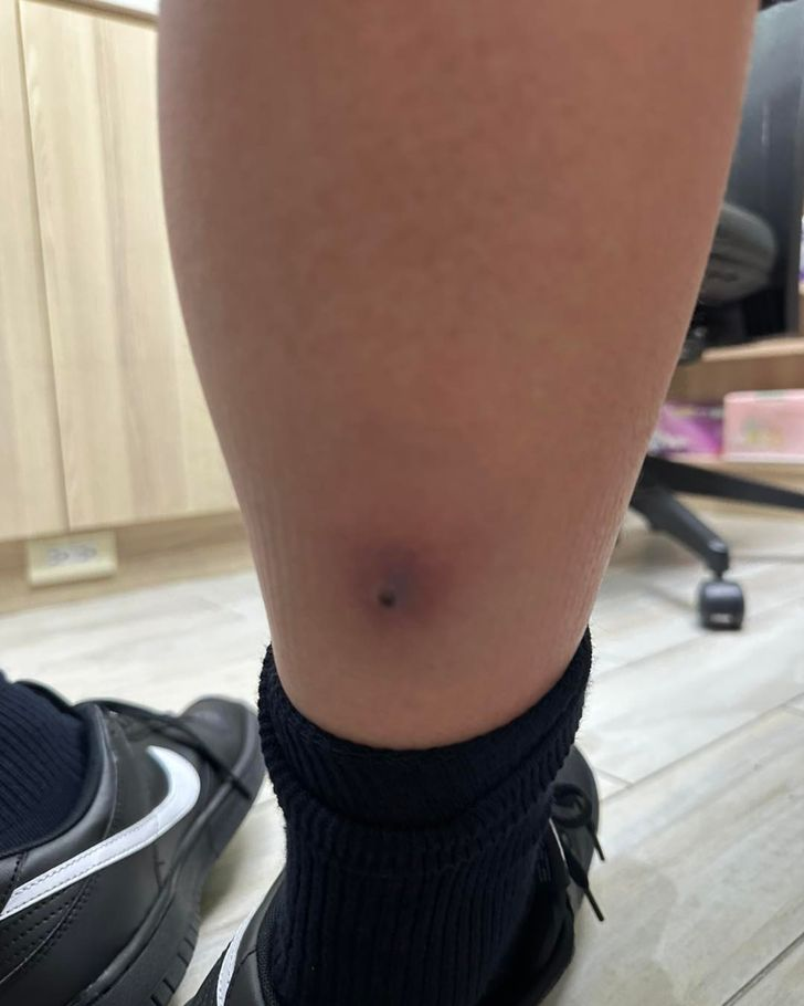 Tưởng chỉ là cúm mùa, bé trai 12 tuổi sốt trở lại: Bác sĩ vén ống quần kiểm tra liền yêu cầu cấp cứu khẩn cấp - Ảnh 1.