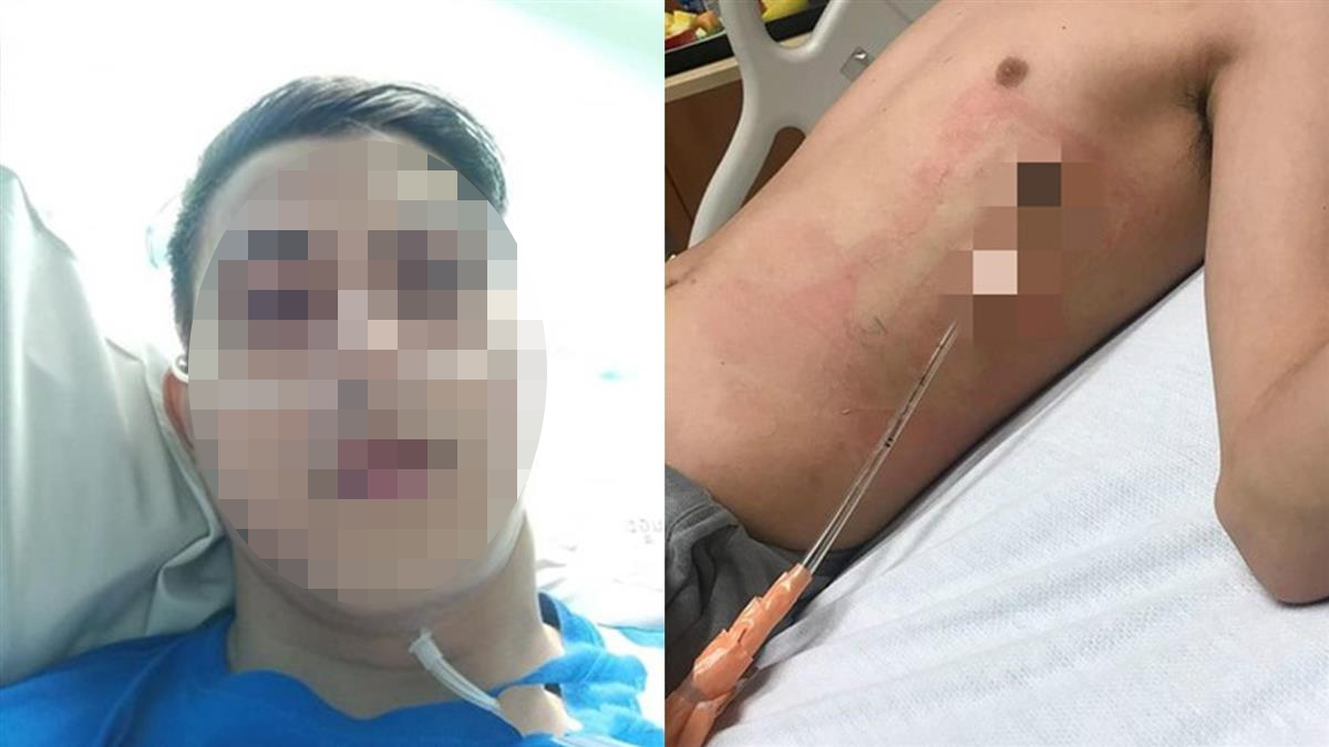 Chỉ vươn vai buổi sáng, nam sinh 17 tuổi bị “xẹp phổi”- Ảnh 1.