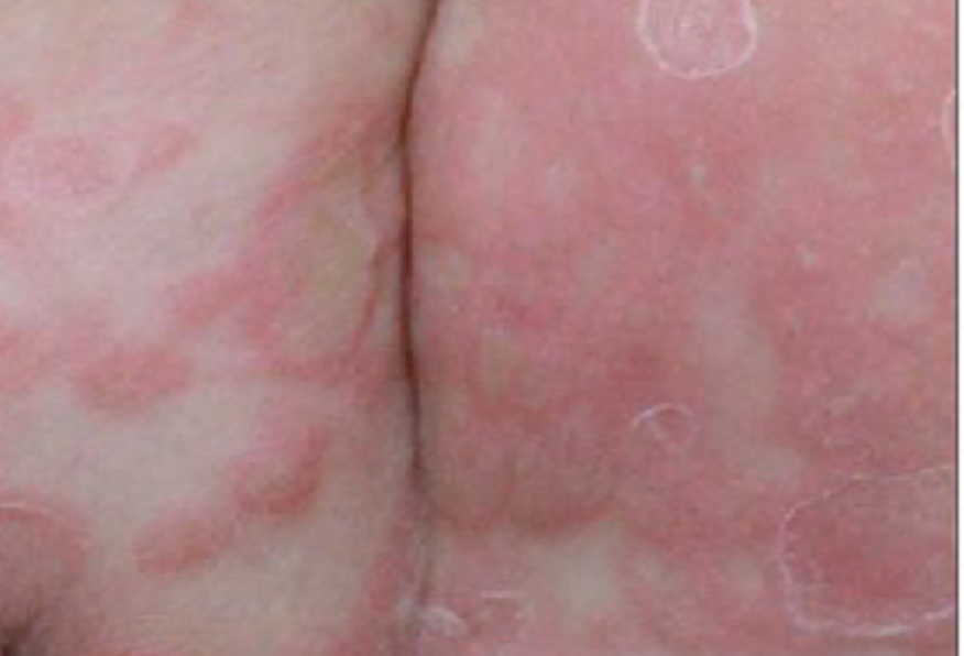 B&eacute; trai 3 tuổi bị giang mai bẩm sinh d&ugrave; kh&ocirc;ng c&oacute; triệu chứng - Ảnh 3.