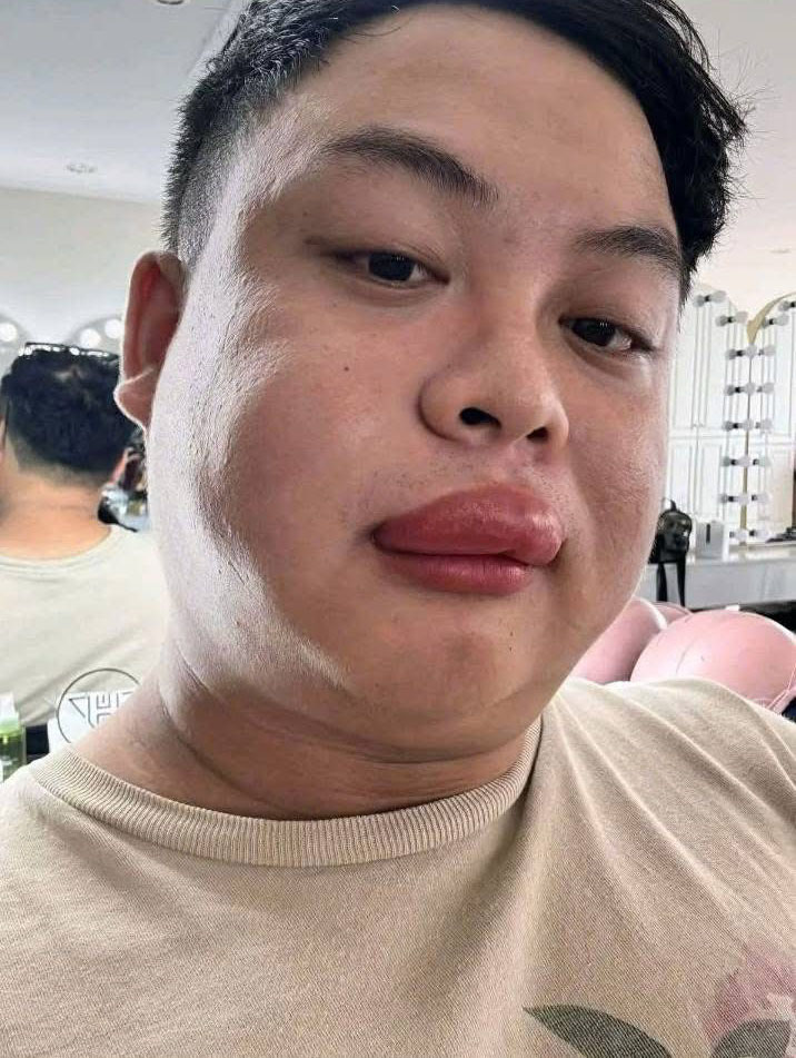 Cô dâu bị ong đốt, thợ make up đến “cứu” cũng bị đốt sưng môi: Người trong cuộc kể chuyện hy hữu - Ảnh 2.