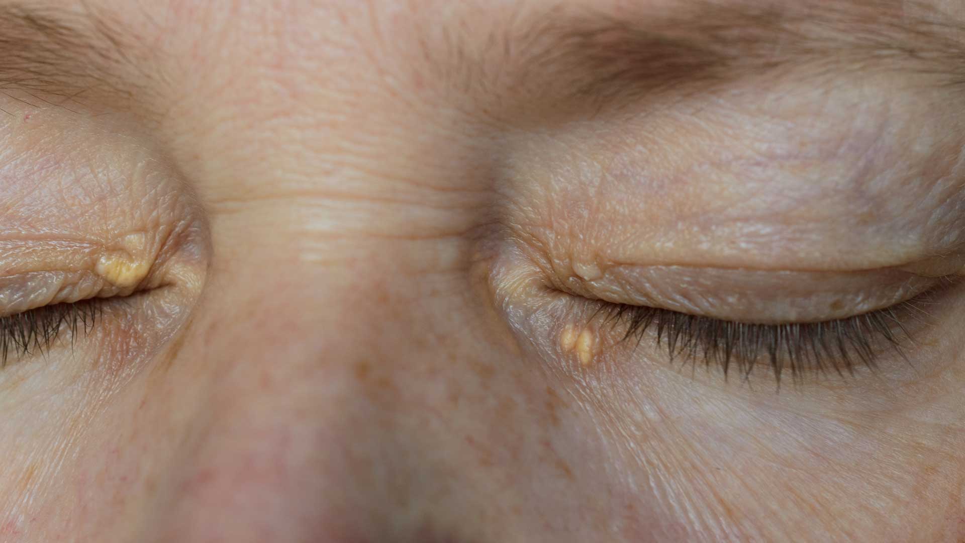 7 dấu hiệu của người có mỡ máu cao: Sau 40 tuổi nếu không có thì xin chúc mừng! - Ảnh 2. 7 dấu hiệu của người có mỡ máu cao: Sau 40 tuổi nếu không có thì xin chúc mừng! - Ảnh 2.