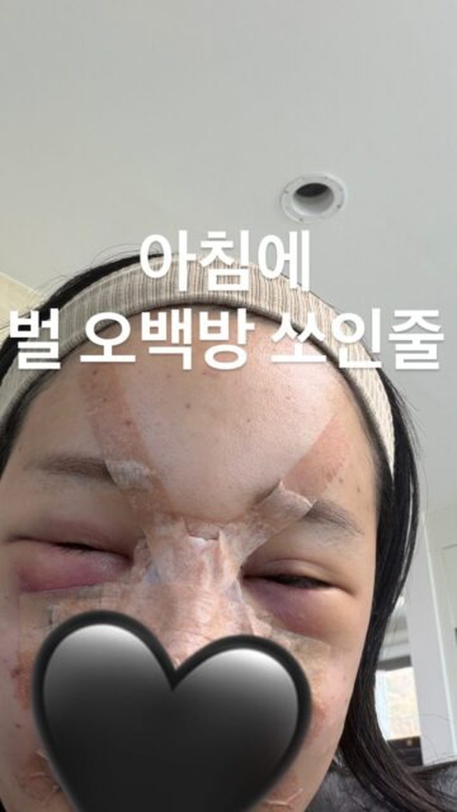 Trùng tu nhan sắc để ăn Tết, 1 sao nữ mặt mũi biến dạng, sưng phồng như bị 