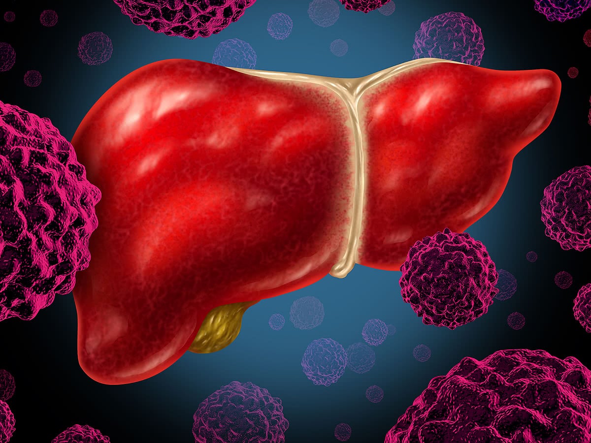 Ung thư đại trực tr&agrave;ng gia tăng ở người trẻ: Đ&acirc;y l&agrave; 11 c&aacute;ch ph&ograve;ng ngừa, bạn l&agrave;m được mấy? - Ảnh 3.