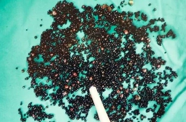 Ch&agrave;ng trai mới 20 tuổi đ&atilde; phải chạy thận suốt phần đời c&ograve;n lại, b&aacute;c sĩ lắc đầu: 1 năm trước cơ thể đ&atilde; k&ecirc;u cứu nhưng đều bị bỏ qua - Ảnh 2.