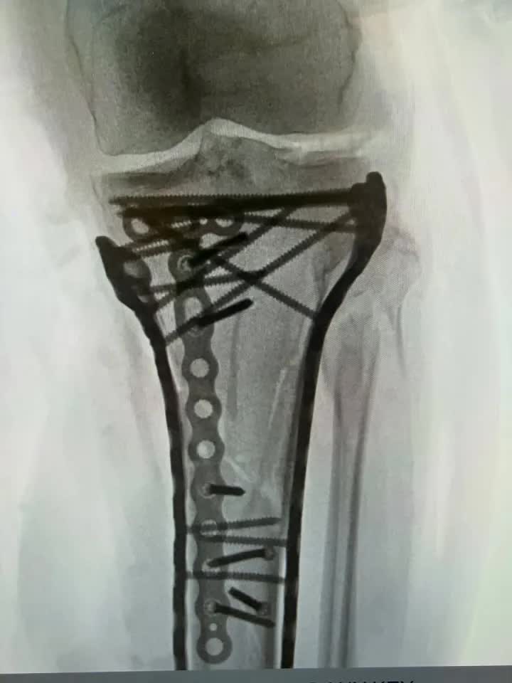 X&uacute;c động lời nhắn Ronaldo gửi nữ thần trượt tuyết su&yacute;t phải cắt cụt ch&acirc;n sau tai nạn kinh ho&agrave;ng ở Olympic - Ảnh 2.