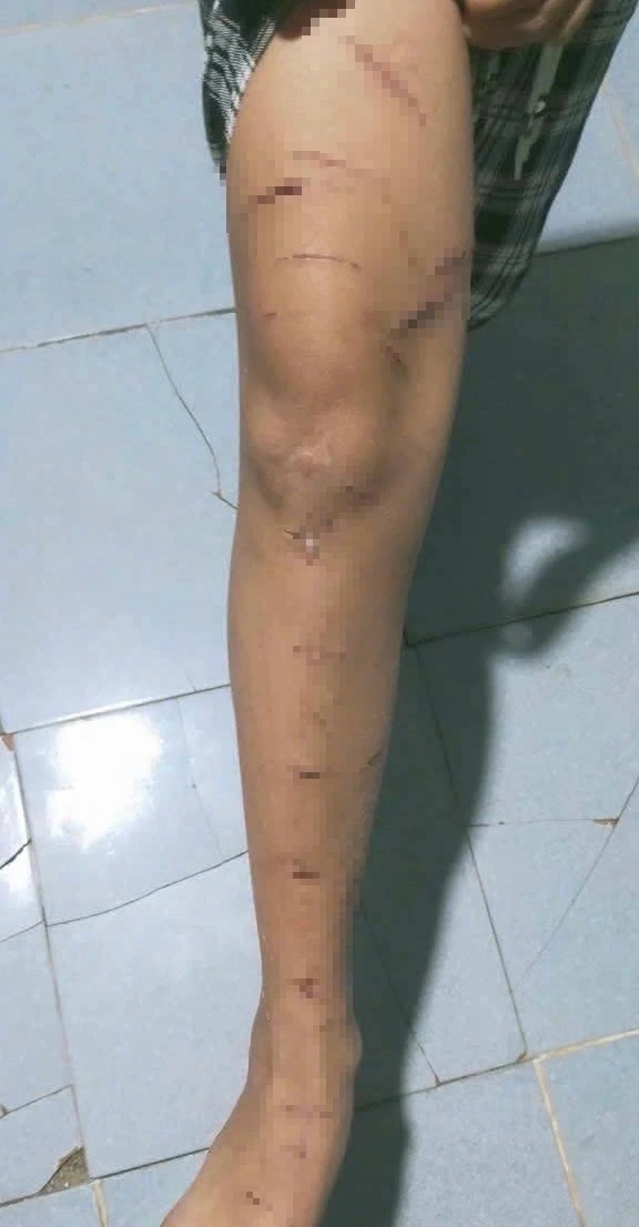 Vụ bé gái bị chị họ 12 tuổi dùng dao rạch khắp người: Mâu thuẫn từ việc em giật áo chị rủ chơi cùng- Ảnh 2. Vụ bé gái bị chị họ 12 tuổi dùng dao rạch khắp người: Mâu thuẫn từ việc em giật áo chị rủ chơi cùng- Ảnh 2.