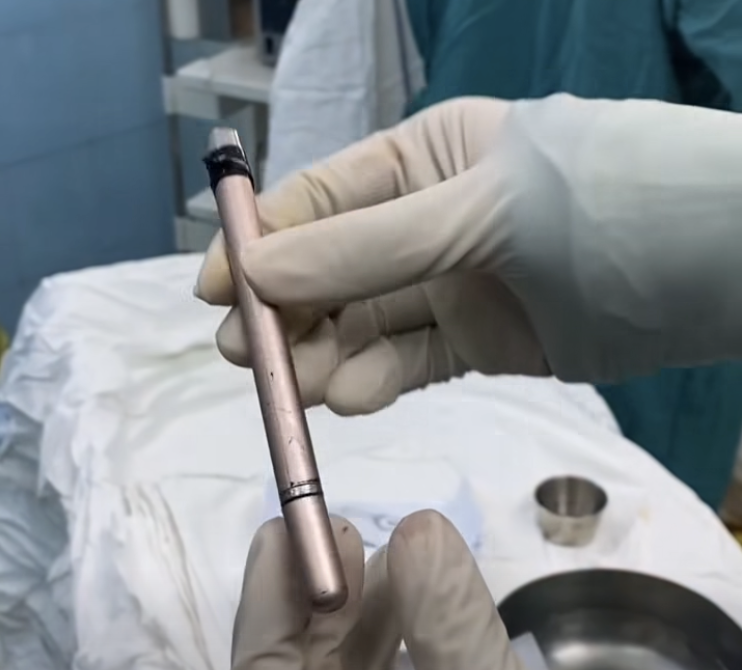 Thiếu nữ dùng cây bút gãi ngứa vùng kín rồi bị mắc kẹt trong bàng quang- Ảnh 1.