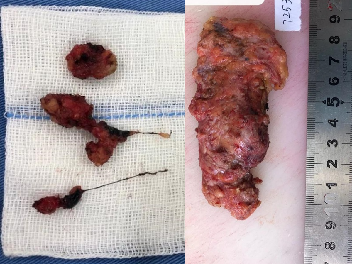 Mẹ vô tình phát hiện dịch màu vàng trên áo lót bé gái 13 tuổi, kết quả siêu âm gây sốc vì…- Ảnh 2.